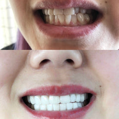 微笑齿线🦷明星同款全瓷美白牙贴面，彻底点亮您的笑容！